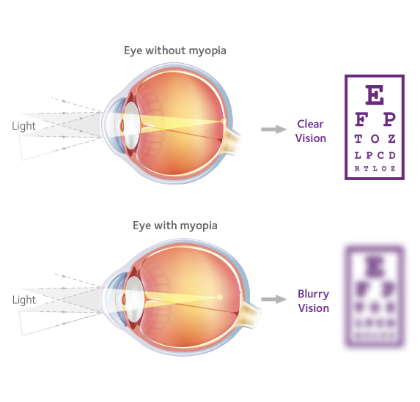eye chart