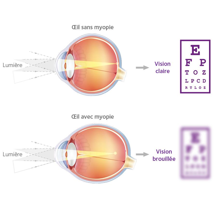 eye chart FR