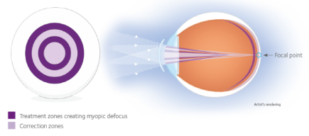 multifocal contacts myopia control